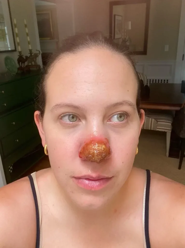 Jessica's selfie. We can see the lesion on her nose.